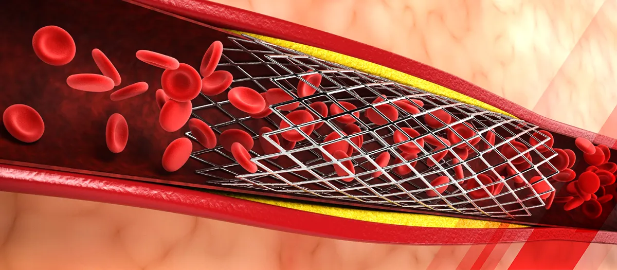 Venous Stents: Revolutionizing Vascular Health and Blood Circulation